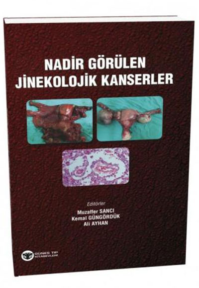 Güneş Tıp Nadir Görülen Jinekolojik Kanserler Ali Ayhan Güneş Tıp